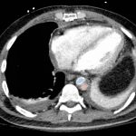 Acute Aortic Dissection Presenting Exclusively as Lower Extremity Paresthesias 2 Creative Commons images