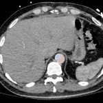 Acute Aortic Dissection Presenting Exclusively as Lower Extremity Paresthesias 3 Creative Commons images