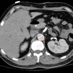Acute Aortic Dissection Presenting Exclusively as Lower Extremity Paresthesias 4 Creative Commons images