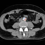 Acute Aortic Dissection Presenting Exclusively as Lower Extremity Paresthesias 5 Creative Commons images