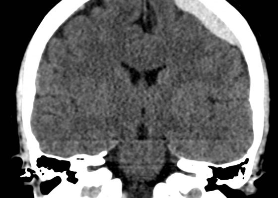 Acute Subdural Hematoma 10 Creative Commons images