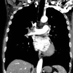 Acute, massive pulmonary embolism with right heart strain and hypoxia requiring emergent tissue plasminogen activator (TPA) infusion 5 Creative Commons images