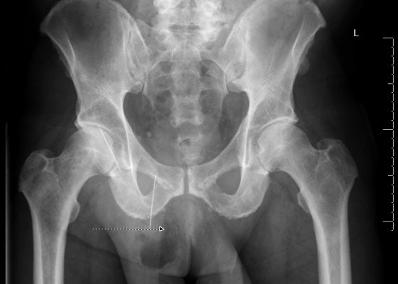 Bowel Perforation complicating an incarcerated inguinal hernia 2 Creative Commons images