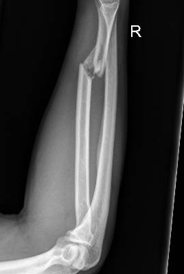 Galeazzi Fracture 16 Creative Commons images