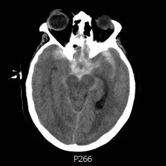 Presentation of Significant Subarachnoid Hemorrhage without Loss of Consciousness 10 Creative Commons images