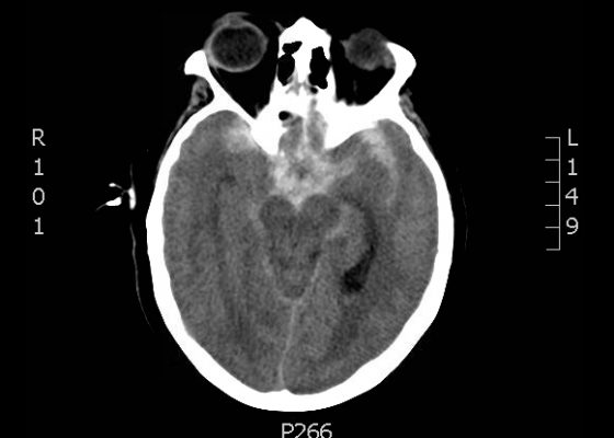 Presentation of Significant Subarachnoid Hemorrhage without Loss of Consciousness 8 Creative Commons images