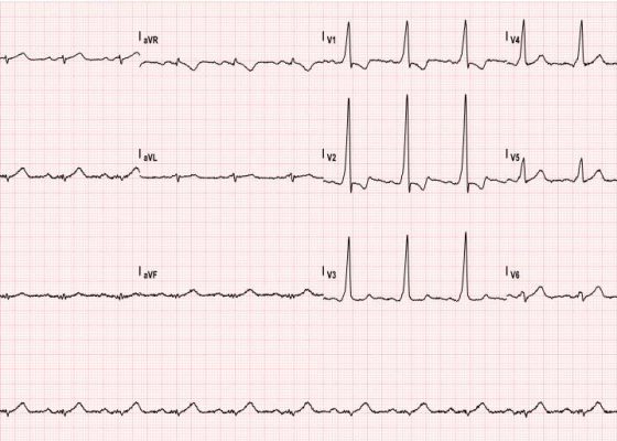 Asymptomatic Wolff-Parkinson-White Syndrome: Incidental EKG 10 Creative Commons images