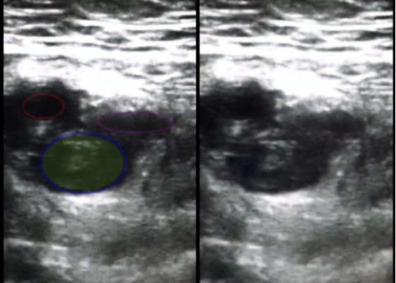 Use of Bedside Compression Ultrasonography for Diagnosis of Deep Venous Thrombosis 16 Creative Commons images