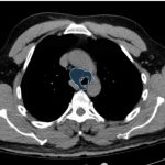 Esophageal Perforation 1 Creative Commons images