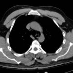 Esophageal Perforation 4 Creative Commons images