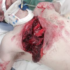 Open Pneumothorax 5 Creative Commons images