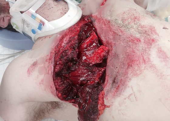 Open Pneumothorax 6 Creative Commons images
