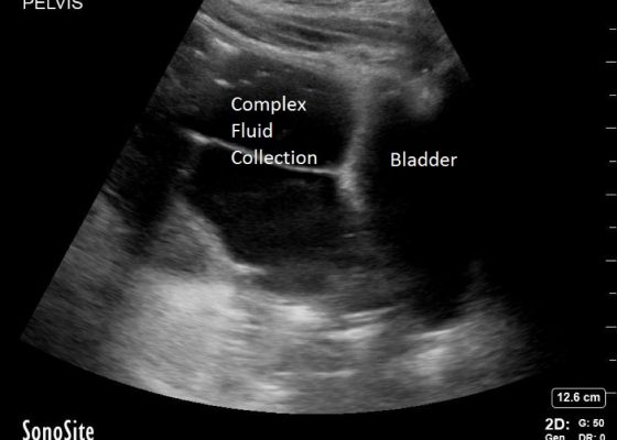 Perforated Gastric Ulcer with Intra-abdominal Abscess 2 Creative Commons images