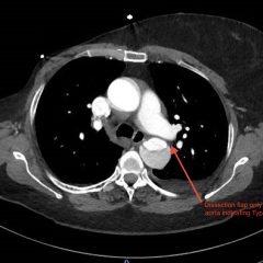Renal Infarction from Type B Aortic Dissection 9 Creative Commons images