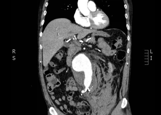 Ruptured Abdominal Aortic Aneurysm 14 Creative Commons images