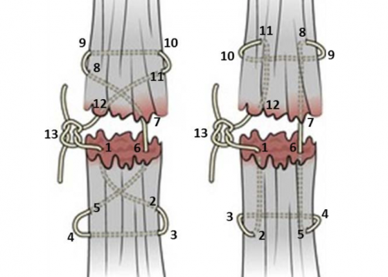 A Simulation Model for Extensor Tendon Repair 2 Creative Commons images