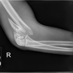 Supracondylar Fracture 6 Creative Commons images