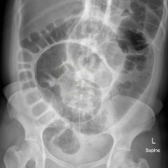 Volvulus 5 Creative Commons images