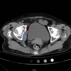 Acetabular Fracture 7 Creative Commons images