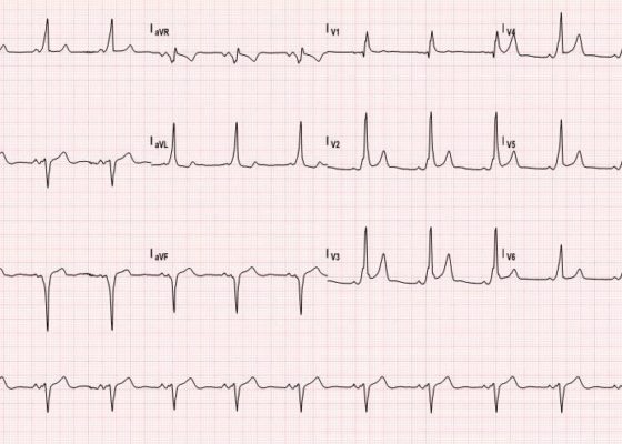 Management of Wolff-Parkinson-White Tachyarrhythmia Presenting as Syncope with Seizure-like Activity 2 Creative Commons images