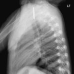 Pediatric Esophageal Foreign Body 2 Creative Commons images