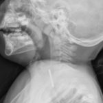 Pediatric Esophageal Foreign Body 3 Creative Commons images