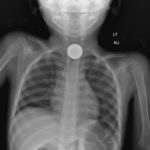 Pediatric Esophageal Foreign Body 1 Creative Commons images