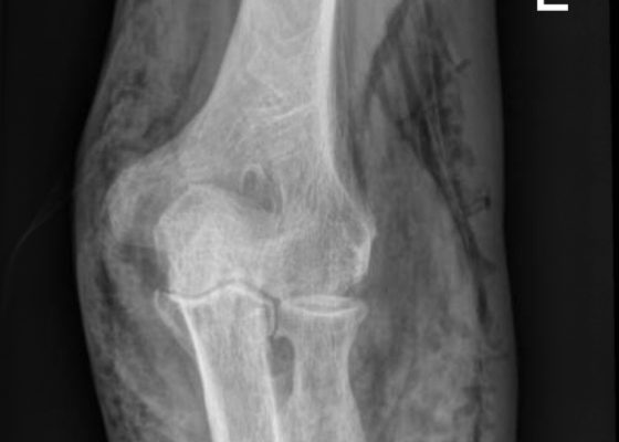 Subcutaneous Emphysema in Non-Necrotizing Soft Tissue Injury 6 Creative Commons images