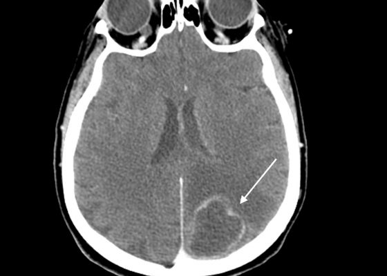 Viridans streptococci Intracranial Abscess Masquerading as Metastatic Disease 8 Creative Commons images