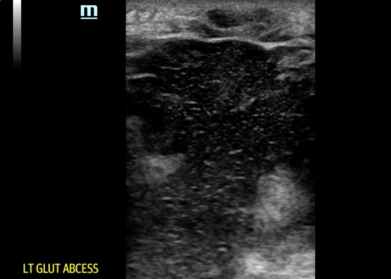 Point-of-care Ultrasound for the Diagnosis of a Gluteal Abscess 10 Creative Commons images
