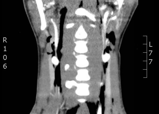 Pneumomediastinum After Cervical Stab Wound 12 Creative Commons images