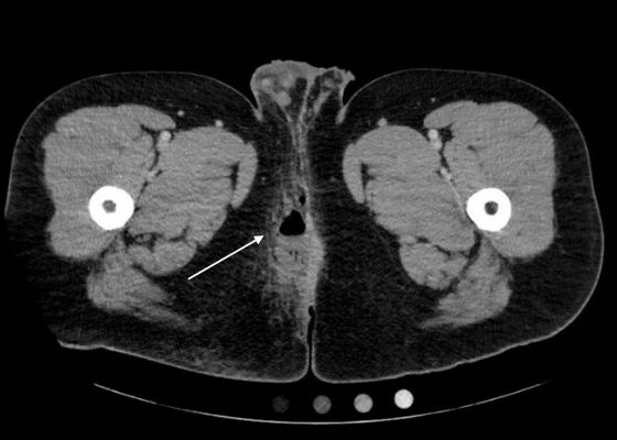 Perianal Abscess 12 Creative Commons images