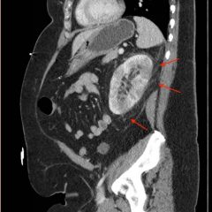 Acute Pyelonephritis with Perinephric Stranding on CT 3 Creative Commons images