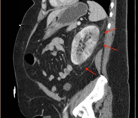 Acute Pyelonephritis with Perinephric Stranding on CT 14 Creative Commons images