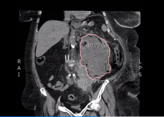 Computed Tomography and Ultrasound Diagnosis of Spontaneous Subcapsular Renal Hematoma 16 Creative Commons images