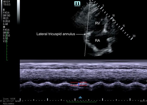 Tricuspid Annular Plane Systolic Excursion (TAPSE) in a Patient with Pulmonary Emboli 6 Creative Commons images
