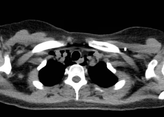 Spontaneous Pneumomediastinum: Hamman Syndrome 10 Creative Commons images