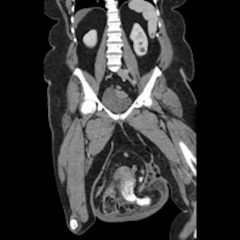 Large Ventral Hernia 8 Creative Commons images