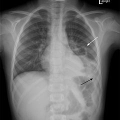 Pediatric Pulmonary Abscess 7 Creative Commons images