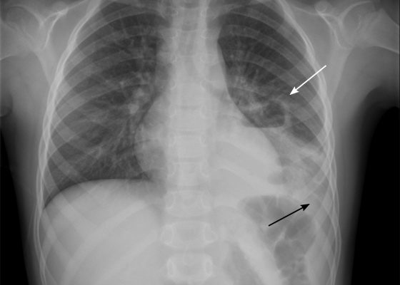 Pediatric Pulmonary Abscess 4 Creative Commons images