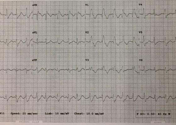 Propafenone Overdose-induced Arrhythmia and Subsequent Correction After Administration of Sodium Bicarbonate 16 Creative Commons images