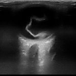 Retinal Detachment 2 Creative Commons images