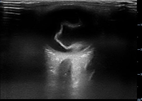 Retinal Detachment 6 Creative Commons images