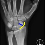 Scaphoid Fracture 2 Creative Commons images