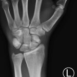 Scaphoid Fracture 4 Creative Commons images