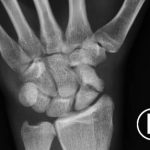 Scaphoid Fracture 3 Creative Commons images