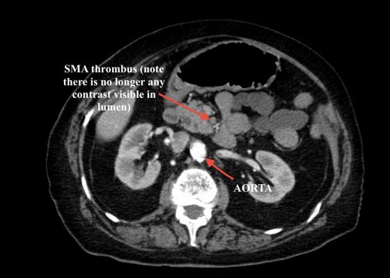 Elderly female with acute abdominal pain presenting with Superior Mesenteric Artery Thrombus 4 Creative Commons images