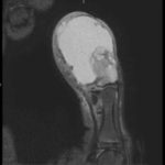 Rare Rapidly Growing Thumb Lesion in a 12-Year-Old Male 3 Creative Commons images
