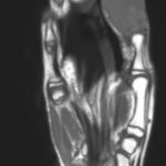 Rare Rapidly Growing Thumb Lesion in a 12-Year-Old Male 4 Creative Commons images