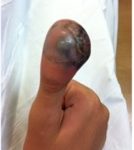 Rare Rapidly Growing Thumb Lesion in a 12-Year-Old Male 1 Creative Commons images